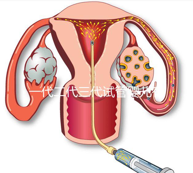 一代二代三代試管嬰兒有什么區(qū)別
