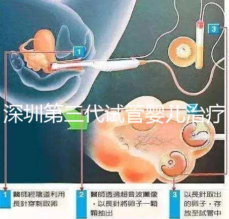 深圳第三代試管嬰兒治療大概需要多少錢？詳細費用清單助您了解預(yù)算